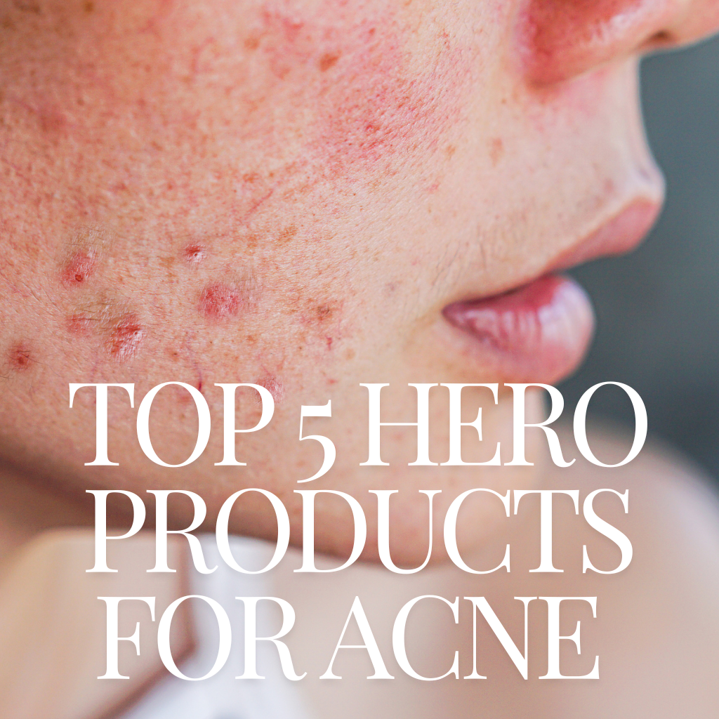 Acne Awareness Month: Targeted Solutions at UK Beauty Club